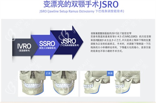 JSRO双颚