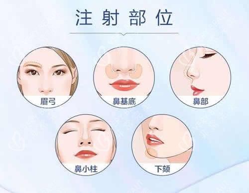 铂安润玻尿酸注射部位