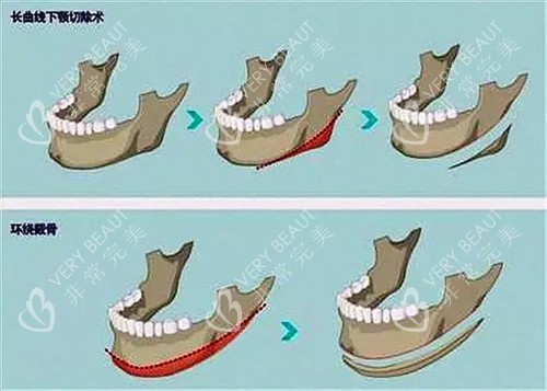 不同下颌骨结构方式对比图