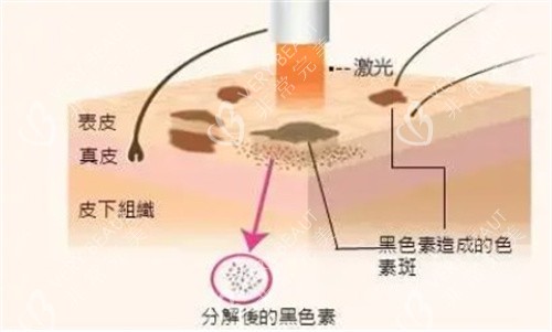 激光祛斑手术原理图