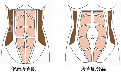 腹壁成形术前后腹直肌的变化图解