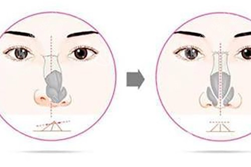 鼻矫正示意图