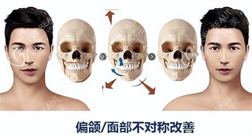 正颌手术原理与对比展示动画图