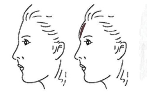额头填充侧面卡通示意图