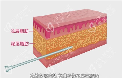 深层脂肪和浅层脂肪