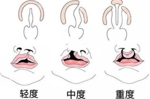 唇腭裂按不同程度划分