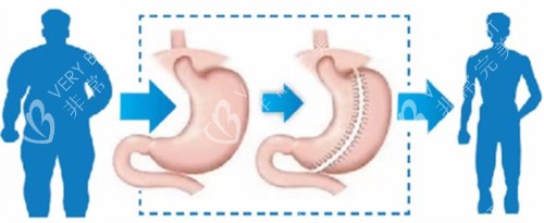 袖状胃切除手术图示