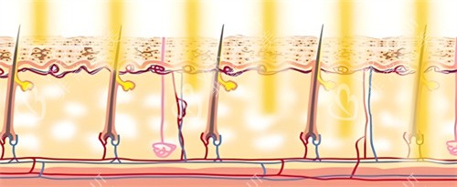 光子嫩肤作用图