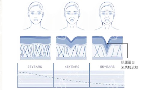 胶原蛋白流失的皮肤