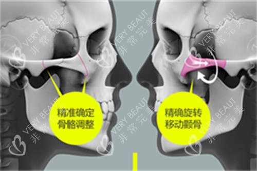 北京圣嘉新医疗美容医院张笑天颧骨颧弓整形示意图