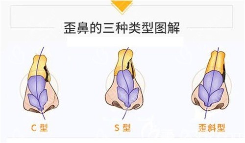 歪鼻的三种类型图解