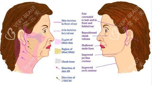 面部提升手术对比图