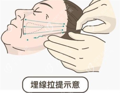 埋线提升面部的操作过程