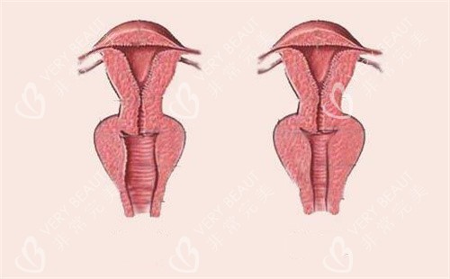 女性阴道松弛和紧致对比