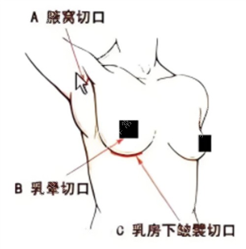 假体隆胸手术切口位置