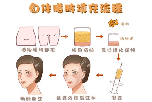自体脂肪移植填充额头动画演示图