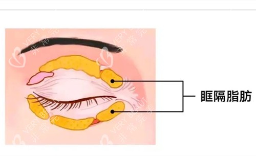 眼周眶隔脂肪卡通示意图