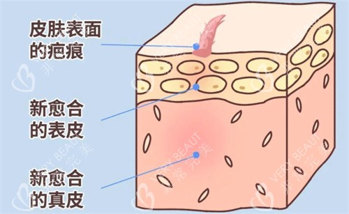 疤痕的形成过程