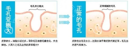 正常毛孔和粗大毛孔