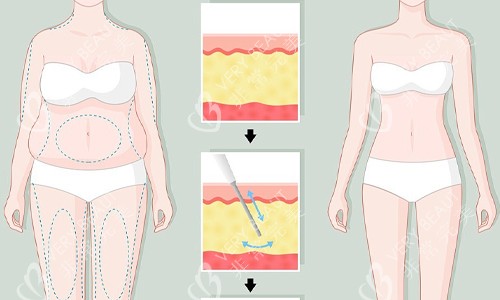 全身吸脂展示图