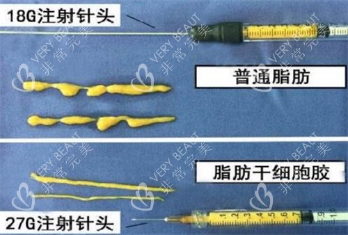 自体脂肪填充需要的脂肪提纯后的样子图片