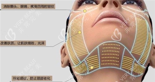 热玛吉皮肤作用细节图