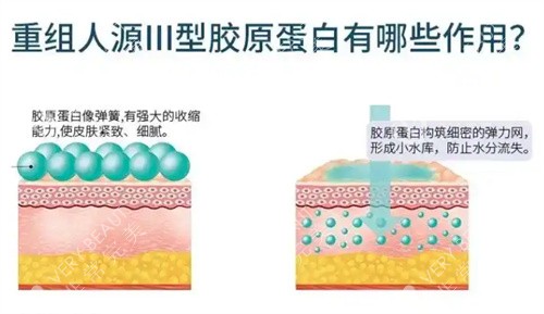 重组三型胶原蛋白有哪些作用