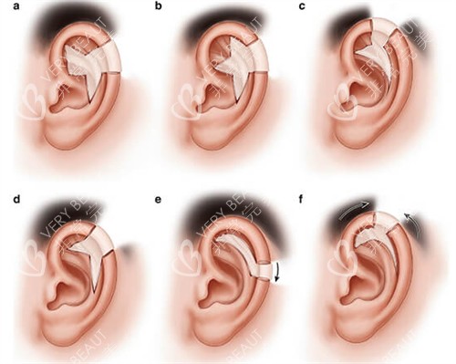 不同情况的耳畸形