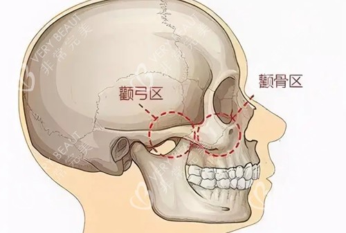 颧弓颧骨位置示意图