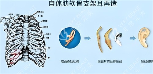 肋软骨直埋耳再造术步骤演示图