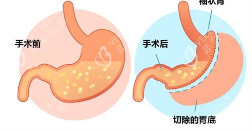 袖状胃切除手术前后对比卡通