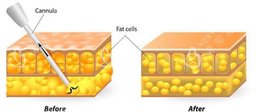 吸脂前后对比图示
