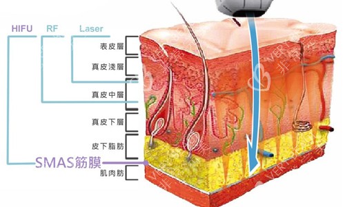 超声炮激光作用原理