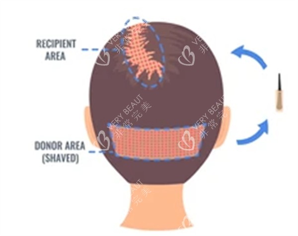 后枕毛囊移植过程图解