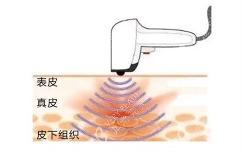 热拉提针对的皮肤层