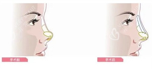 隆鼻手术前后对比