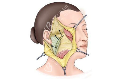 发际耳后切口拉皮手术示意图