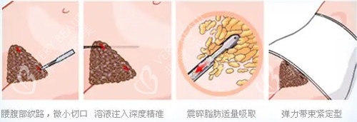 腹部吸脂过程动画图解