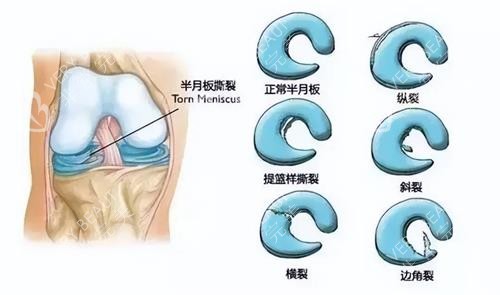 半月板损坏的类型