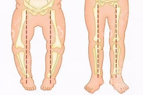 O型腿与正常腿型对比图