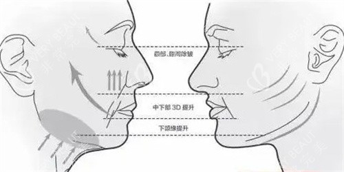 面部提升三大部位