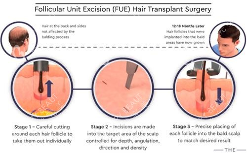 毛囊移植过程图解
