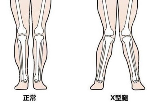 X型腿和正常腿外观示意图