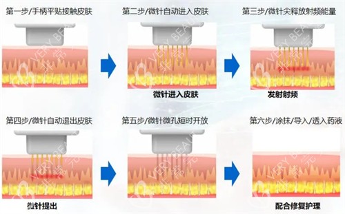 微针操作流程图解