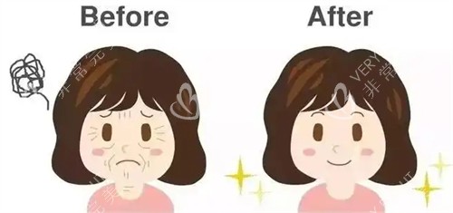面部提升抗衰对比