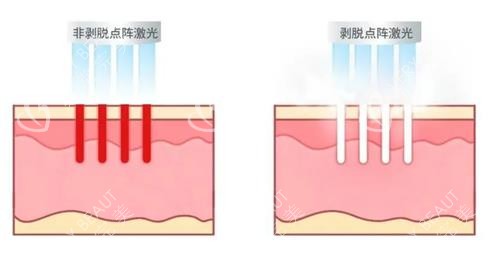 不同类型的点阵激光