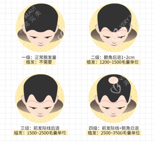 脱发等级展示