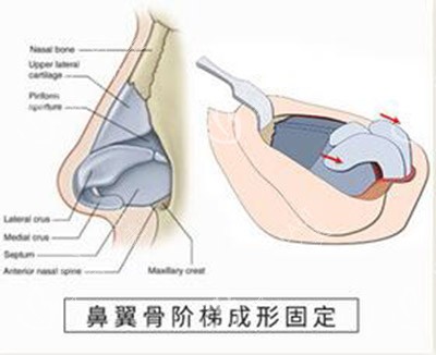 鼻翼骨阶梯成形固定