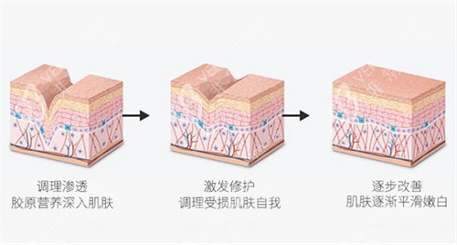 III型胶原蛋白填充原理