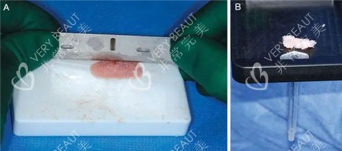 鼻基底手术材料照片